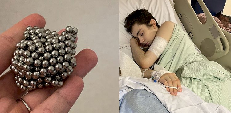 Schoolboy swallows 54 toy magnets, undergoes life-saving surgery